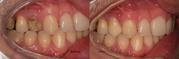 Fractura dentară – recomandare coroana de zirconiu